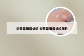 斑秃是银屑病吗 斑秃是银屑病吗图片
