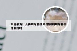 银屑病为什么要切除扁桃体 银屑病切除扁桃体会好吗