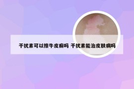 干扰素可以擦牛皮癣吗 干扰素能治皮肤病吗