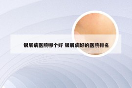 银屑病医院哪个好 银屑病好的医院排名