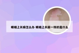 眼睛上长癣怎么办 眼睛上长藓一样的是什么