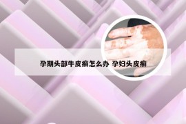 孕期头部牛皮癣怎么办 孕妇头皮癣