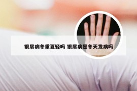 银屑病冬重夏轻吗 银屑病是冬天发病吗