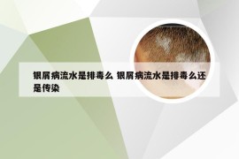 银屑病流水是排毒么 银屑病流水是排毒么还是传染