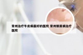 常州治疗牛皮癣最好的医院 常州银屑病治疗医院