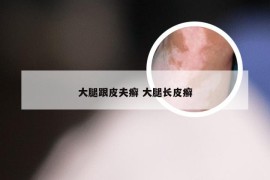 大腿跟皮夫癣 大腿长皮癣