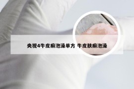 央视4牛皮癣泡澡单方 牛皮肤癣泡澡