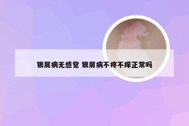 银屑病无感觉 银屑病不疼不痒正常吗