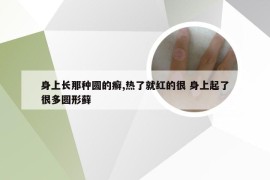 身上长那种圆的癣,热了就红的很 身上起了很多圆形藓