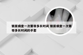 银屑病查一次要带多长时间 银屑病查一次要带多长时间的手套
