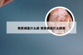 银屑病是什么癣 银屑病是什么癣类