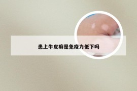 患上牛皮癣是免疫力低下吗