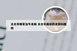 太仓市哪家治牛皮癣 太仓市最好的皮肤科医院