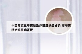 中国那家三甲医院治疗银屑病最好的 哪所医院治银屑病正规
