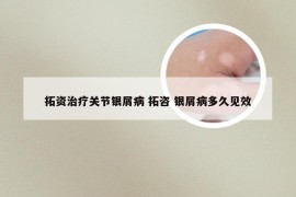 拓资治疗关节银屑病 拓咨 银屑病多久见效
