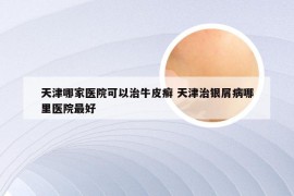 天津哪家医院可以治牛皮癣 天津治银屑病哪里医院最好