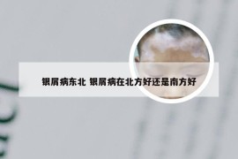 银屑病东北 银屑病在北方好还是南方好
