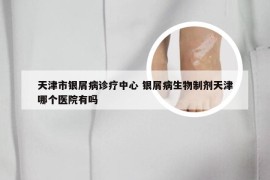 天津市银屑病诊疗中心 银屑病生物制剂天津哪个医院有吗