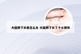 大腿胯下长癣怎么办 大腿胯下长了个小硬块