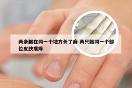 两条腿在同一个地方长了癣 两只腿同一个部位皮肤瘙痒