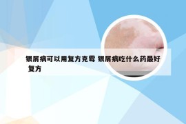 银屑病可以用复方克霉 银屑病吃什么药最好 复方