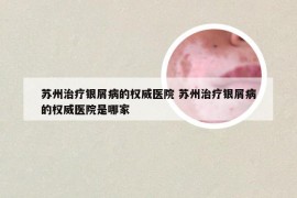 苏州治疗银屑病的权威医院 苏州治疗银屑病的权威医院是哪家