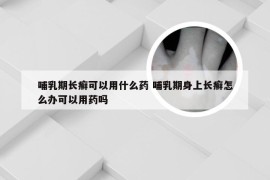 哺乳期长癣可以用什么药 哺乳期身上长癣怎么办可以用药吗