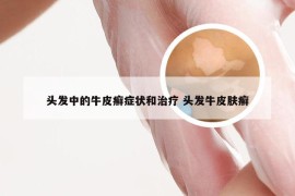 头发中的牛皮癣症状和治疗 头发牛皮肤癣