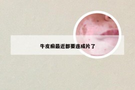 牛皮癣最近都要连成片了