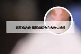 银屑病大连 银屑病适合在大连生活吗