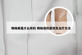 蜘蛛癣是什么样的 蜘蛛疮的症状及治疗方法