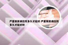 严重银屑病住院多久才能好 严重银屑病住院多久才能好转