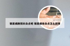 银屑病刚初长白点吧 银屑病有白点怎么回事