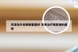 天津治牛皮癣哪里最好 天津治疗银屑病的医院
