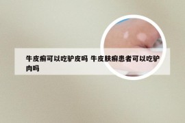 牛皮癣可以吃驴皮吗 牛皮肤癣患者可以吃驴肉吗