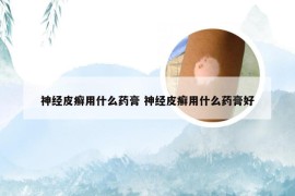 神经皮癣用什么药膏 神经皮癣用什么药膏好