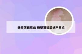 肠壁薄银屑病 肠壁薄银屑病严重吗