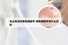 怎么样治好银屑病指甲 银屑病指甲用什么药好