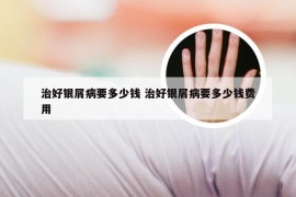 治好银屑病要多少钱 治好银屑病要多少钱费用