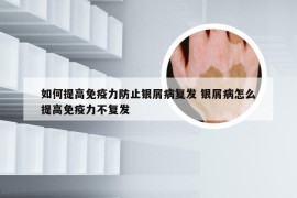 如何提高免疫力防止银屑病复发 银屑病怎么提高免疫力不复发