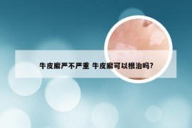 牛皮廨严不严重 牛皮廨可以根治吗?