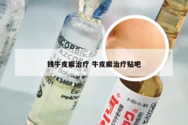 钱牛皮廨治疗 牛皮廨治疗贴吧