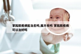 掌跖脓疱病能治愈吗,偏方有吗 掌跖脓疱病可以治好吗