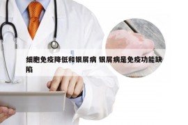 细胞免疫降低和银屑病 银屑病是免疫功能缺陷