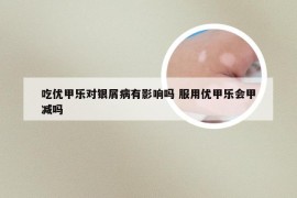吃优甲乐对银屑病有影响吗 服用优甲乐会甲减吗
