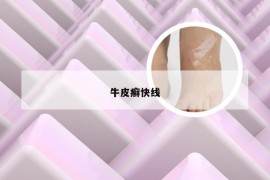 牛皮癣快线
