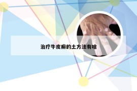 治疗牛皮癣的土方法有啥