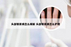 头部银屑病怎么缓解 头部银屑病怎么护理