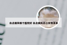 白点癫风哪个医院好 白点癫风忌口食物清单