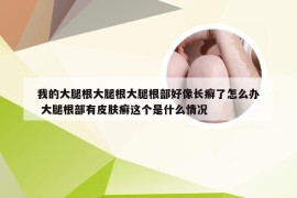 我的大腿根大腿根大腿根部好像长癣了怎么办 大腿根部有皮肤癣这个是什么情况